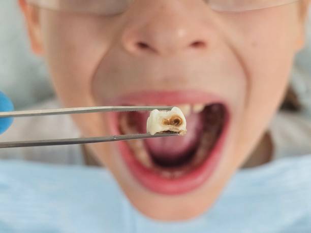 Best Chipped Tooth Repair Near Me  in Aquebogue, NY